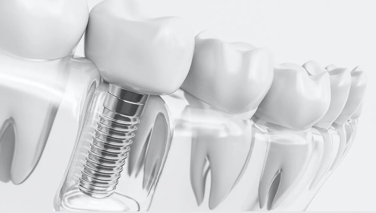 Periimplantitis Nedir? Neden Olur? Belirtileri Nelerdir? Periimplantitis Nedir
