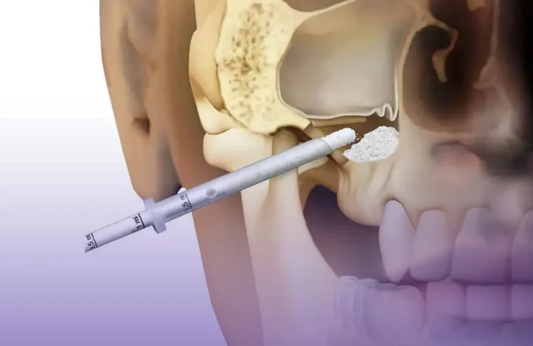 Sinüs Lifting Nedir? Neden Olur? Nasıl Tedavi Edilir? Sinus Lifting