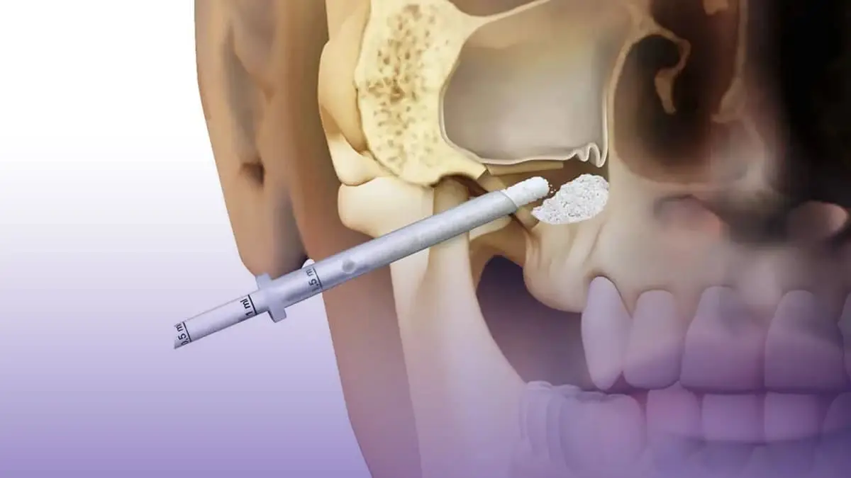 Sinüs Lifting Nedir? Neden Olur? Nasıl Tedavi Edilir? Sinus Lifting