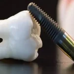 Titanyum Implant