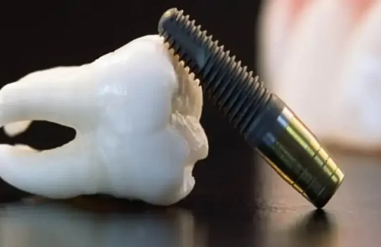 Titanyum İmplant Titanyum Implant