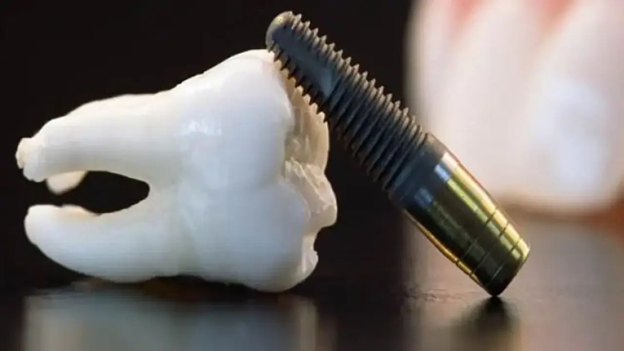 Titanyum İmplant Titanyum Implant