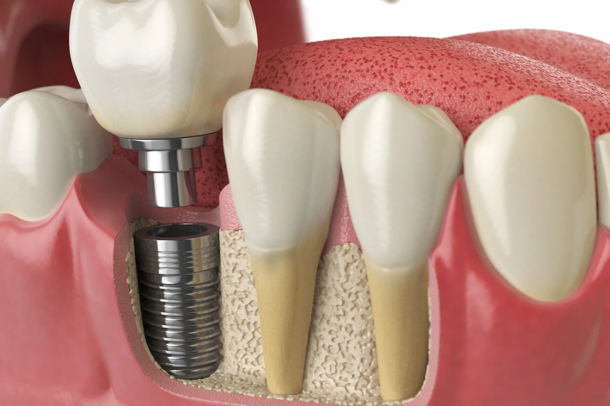 İmplant Sallanması Neden Olur? Implant Sallanmasi Neden Olur